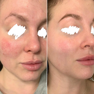 Before and after β Sarah,32