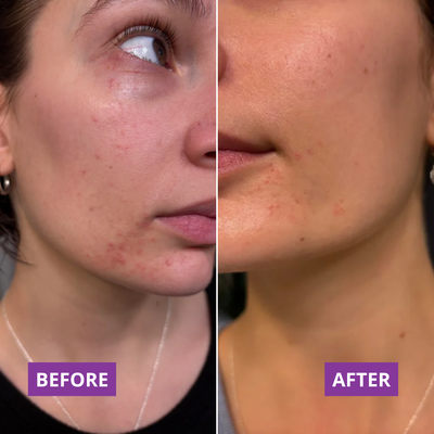 Before and after β Sarah,32